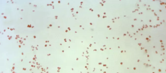 Sexually transmitted disease cases fall, but not syphilis in newborns